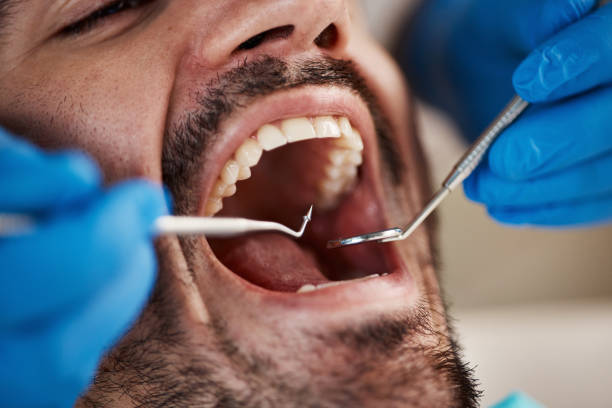 Best Emergency Dental Care for Broken or Chipped Teeth in North Syracuse, NY